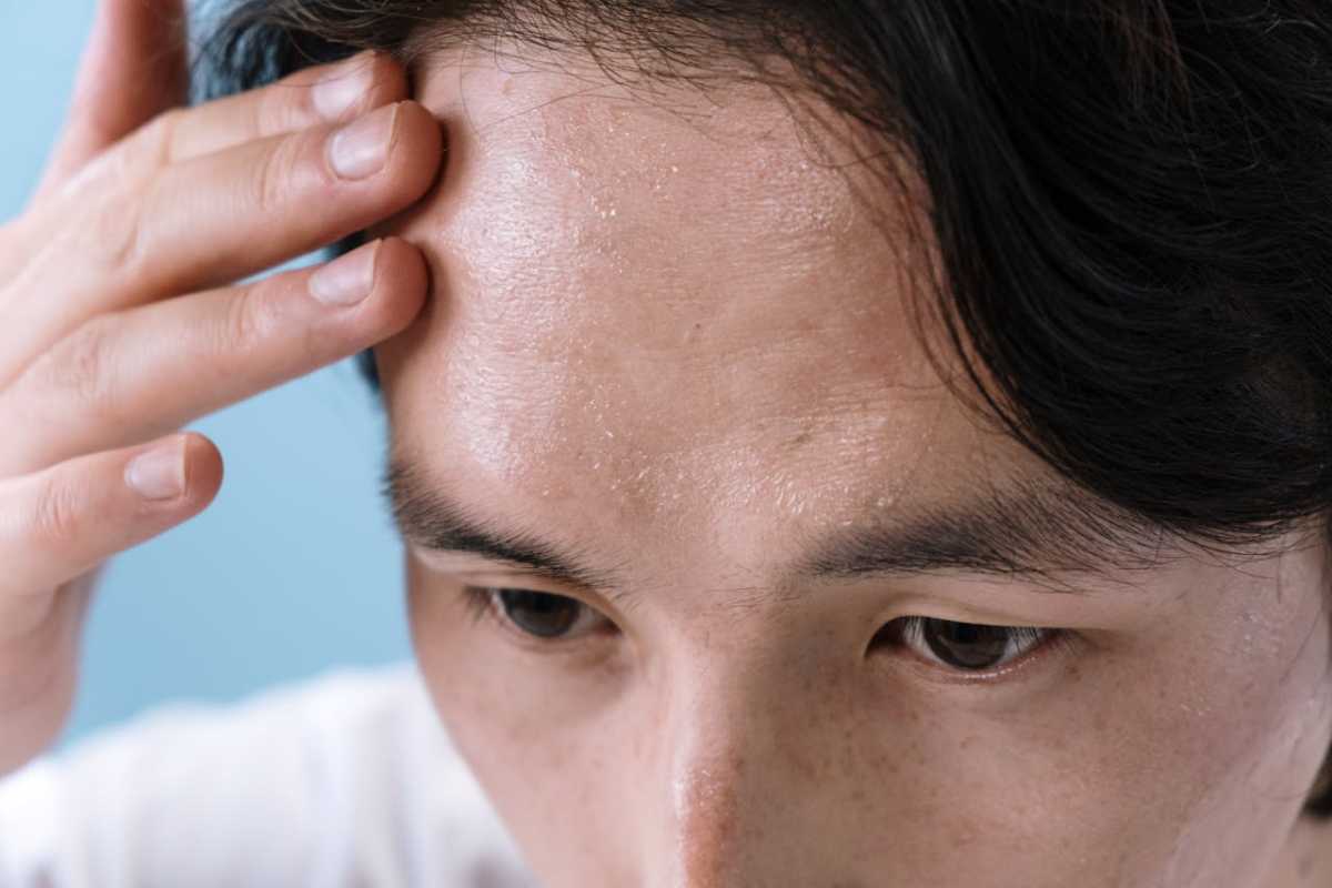 Hyperhidrose : qu’est-ce qui constitue une transpiration excessive ?